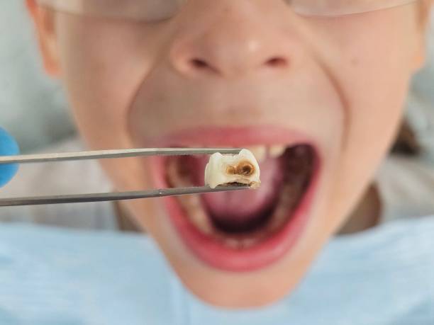 Best Dentist for Tooth Abscess  in Middle River, MD
